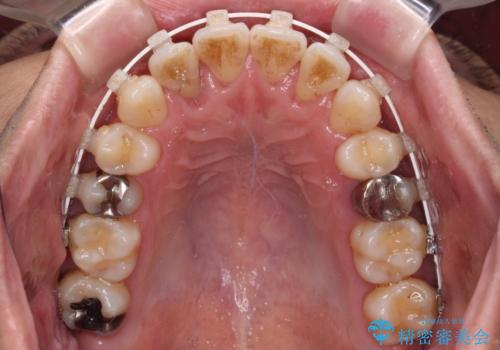 前歯のクロスバイト　目立たないワイヤー装置で矯正治療の治療中