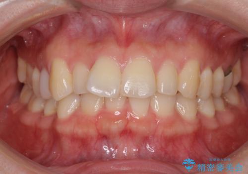 先天欠損のある歯列　インビザライン矯正の症例 治療前