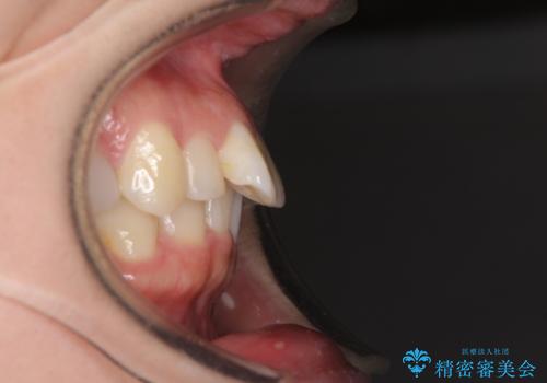 先天欠損のある歯列　インビザライン矯正の治療前