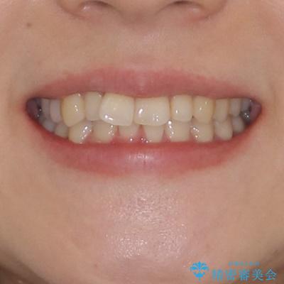 先天欠損のある歯列　インビザライン矯正の治療前（顔貌）