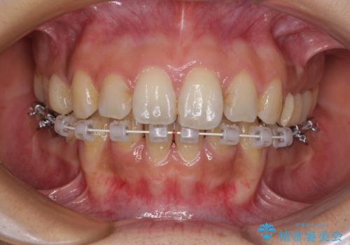 デコボコと口元の突出感 ハーフリンガルでの抜歯矯正の治療中