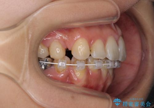 デコボコと口元の突出感 ハーフリンガルでの抜歯矯正の治療中