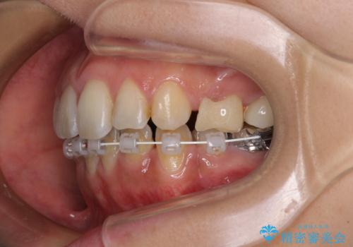 デコボコと口元の突出感 ハーフリンガルでの抜歯矯正の治療中