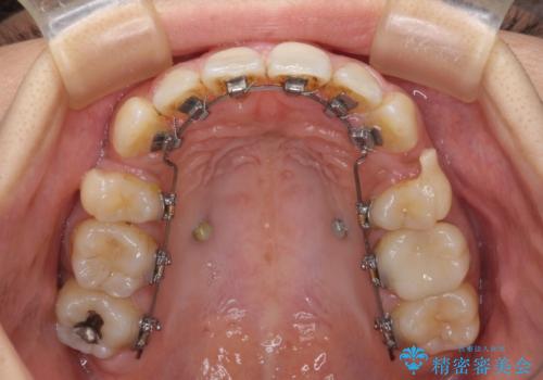 デコボコと口元の突出感　ハーフリンガルでの抜歯矯正の治療中