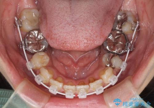 デコボコと口元の突出感　ハーフリンガルでの抜歯矯正の治療中