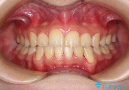出っ歯と深い噛み合わせ:抜歯矯正で口元スッキリ!の症例 治療後
