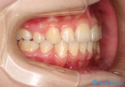 出っ歯と深い噛み合わせ:抜歯矯正で口元スッキリ!の治療後
