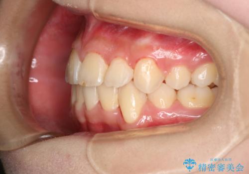 出っ歯と深い噛み合わせ:抜歯矯正で口元スッキリ!の治療後