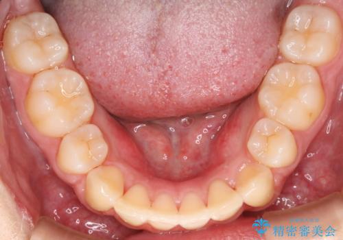 出っ歯と深い噛み合わせ:抜歯矯正で口元スッキリ!の治療後
