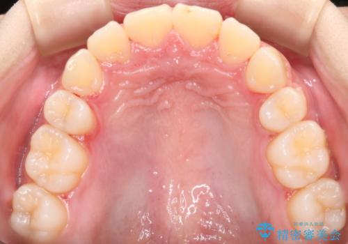 出っ歯と深い噛み合わせ:抜歯矯正で口元スッキリ!の治療後