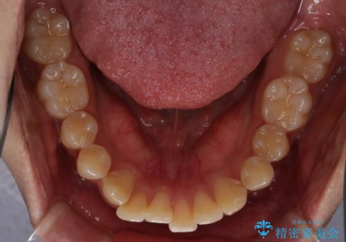 インビザライン:前歯のがたつきと噛み合わせの治療の治療前