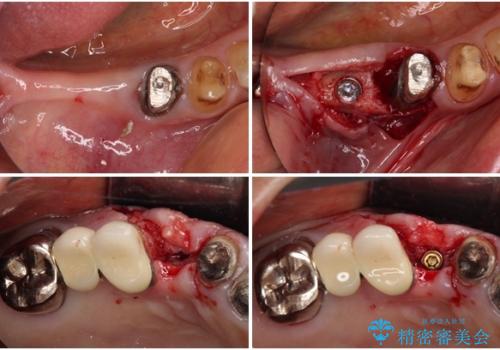 前歯をきれいにしたい インプラントや部分矯正を用いた総合歯科治療の治療中