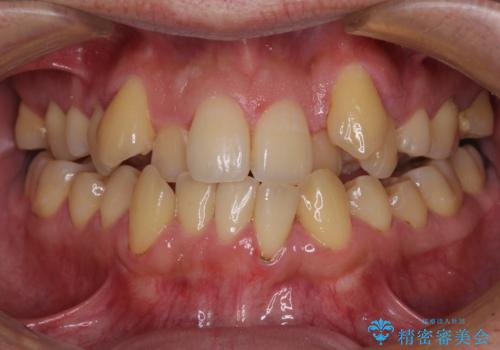 八重歯とクロスバイト　目立たないワイヤー装置で矯正治療の症例 治療前