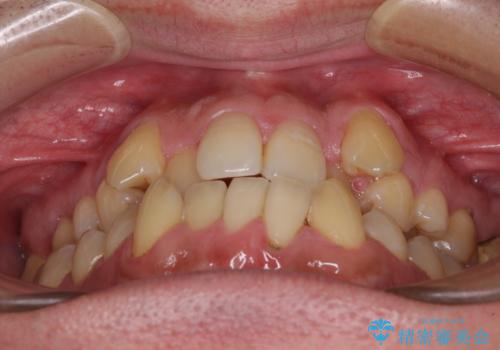 八重歯とクロスバイト 目立たないワイヤー装置で矯正治療の治療前