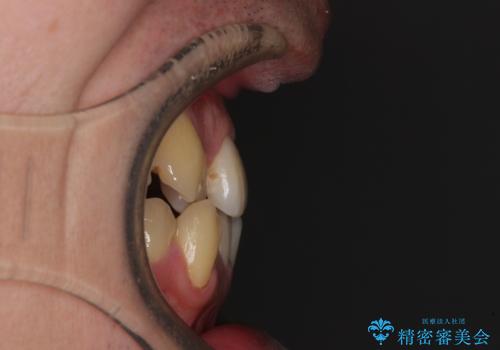 八重歯とクロスバイト 目立たないワイヤー装置で矯正治療の治療前