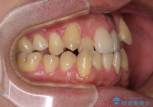 八重歯とクロスバイト 目立たないワイヤー装置で矯正治療の治療前