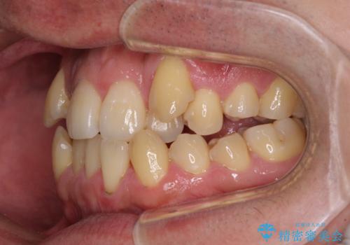 八重歯とクロスバイト 目立たないワイヤー装置で矯正治療の治療前