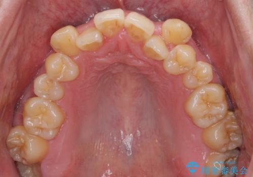 八重歯とクロスバイト 目立たないワイヤー装置で矯正治療の治療前