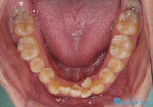 八重歯とクロスバイト　目立たないワイヤー装置で矯正治療の治療前