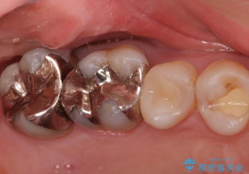 奥歯がしみて痛いの治療前