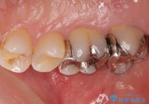 奥歯がしみて痛いの治療前