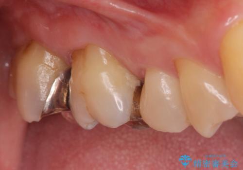 奥歯がしみて痛いの治療前