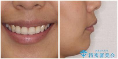 抜歯矯正で唇を閉じやすく 目立たないワイヤー装置の治療後(顔貌)