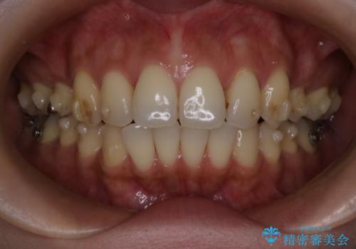 上顎前歯の突出を軽減　インビザラインによる抜歯矯正の治療中