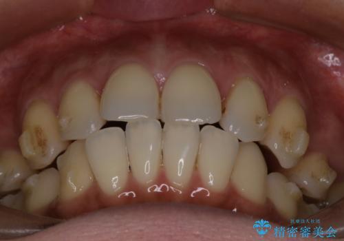 上顎前歯の突出を軽減 インビザラインによる抜歯矯正の治療中
