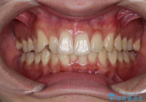 インビザライン:前歯のがたつきと噛み合わせの治療の症例 治療前
