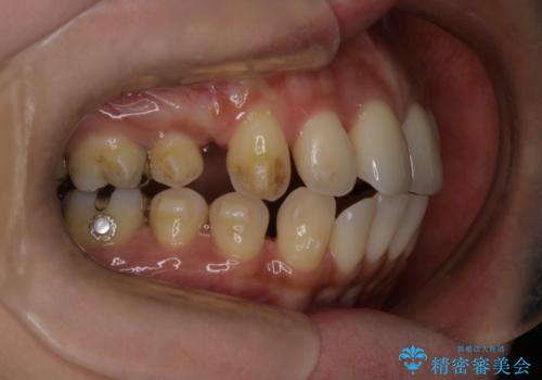 上顎前歯の突出を軽減 インビザラインによる抜歯矯正の治療中