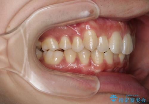 インビザライン:前歯のがたつきと噛み合わせの治療の治療前