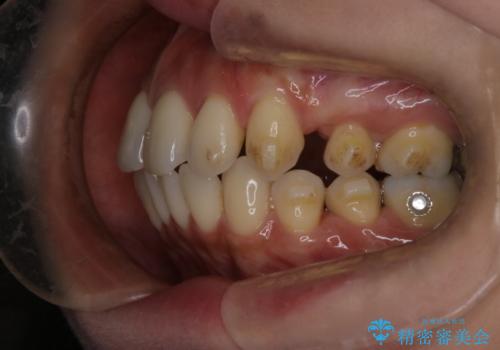 上顎前歯の突出を軽減 インビザラインによる抜歯矯正の治療中