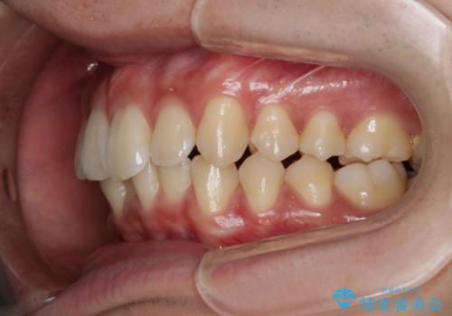 インビザライン:前歯のがたつきと噛み合わせの治療の治療前