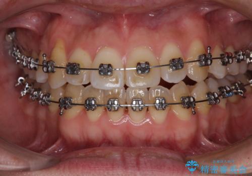 左右の八重歯が気になる　ワイヤー装置での咬み合わせ改善の治療中