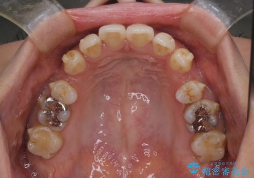 上顎前歯の突出を軽減 インビザラインによる抜歯矯正の治療中