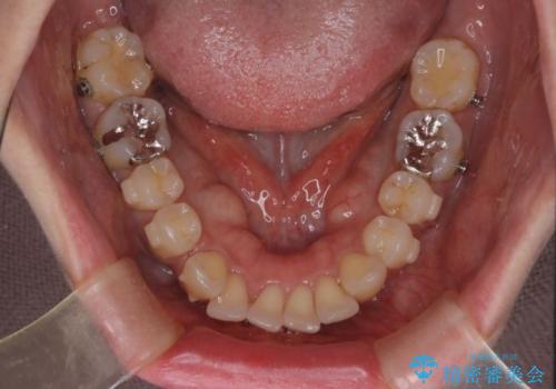上顎前歯の突出を軽減　インビザラインによる抜歯矯正の治療中