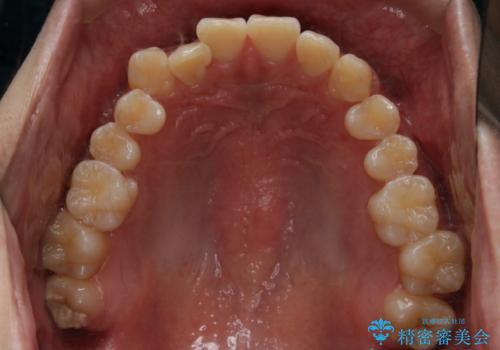 インビザライン:前歯のがたつきと噛み合わせの治療の治療前