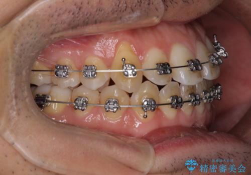 左右の八重歯が気になる　ワイヤー装置での咬み合わせ改善の治療中