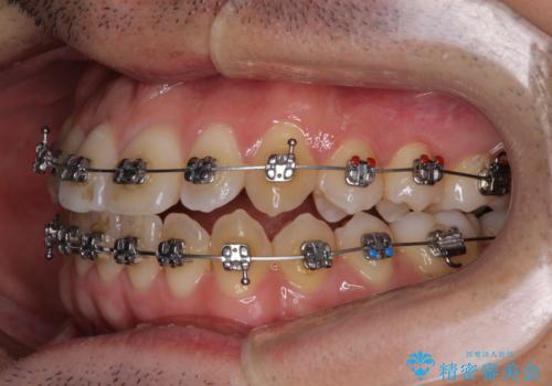 左右の八重歯が気になる ワイヤー装置での咬み合わせ改善の治療中