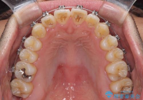 左右の八重歯が気になる ワイヤー装置での咬み合わせ改善の治療中