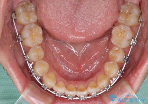 左右の八重歯が気になる ワイヤー装置での咬み合わせ改善の治療中