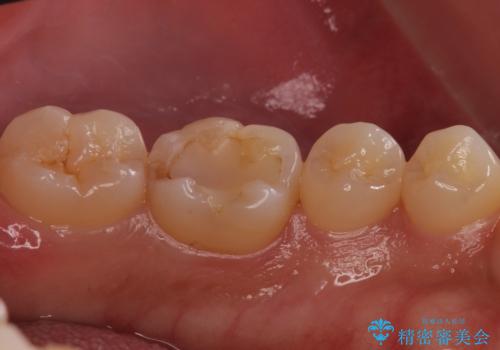 奥歯が欠けた セラミックインレーでの治療の治療前