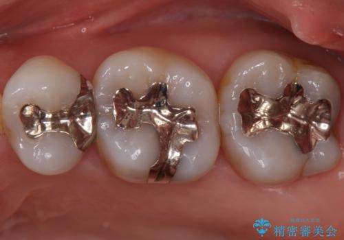 銀歯を白くしたい　セラミックインレーでのやり替えの症例 治療前