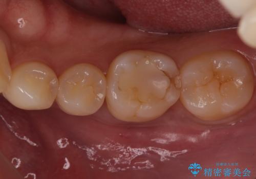 奥歯が欠けた セラミックインレーでの治療の治療前