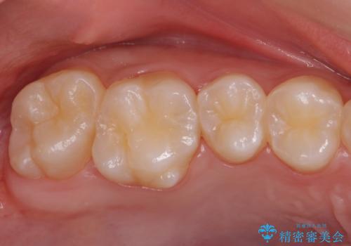 歯と歯の間の虫歯　セラミックインレーでの治療の症例 治療前