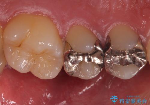銀歯を目立たなくしたい セラミックインレーでの治療の治療前