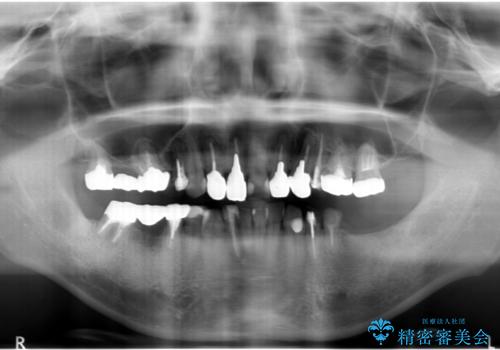 全ての歯を治療したいの治療前