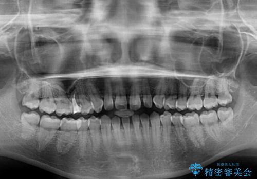 隙間だらけの歯列 インビザラインで改善の治療前