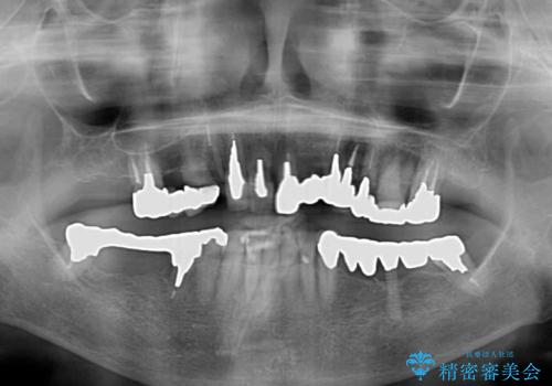 前歯をきれいにしたい インプラントや部分矯正を用いた総合歯科治療の治療前